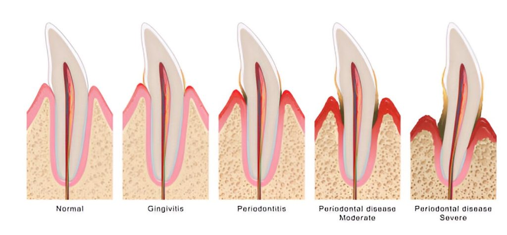 gum disease