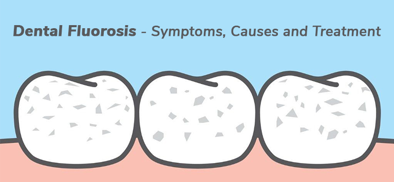 Dental Fluorosis