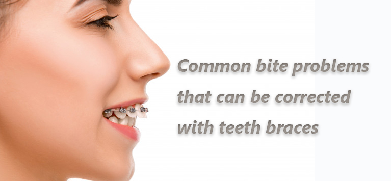 dental braces for bite issue