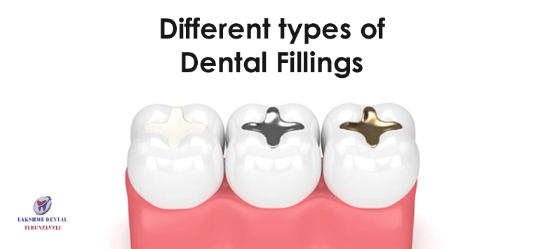 Different types of dental fillings