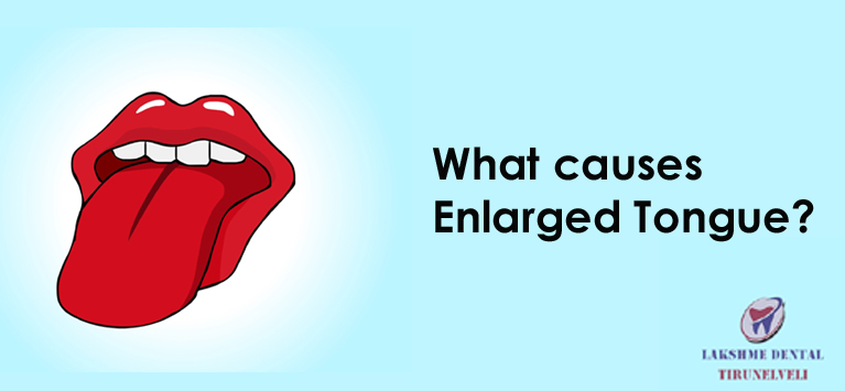 What causes enlarged tongue