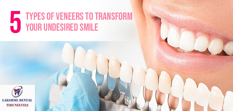 5 types of dental venners