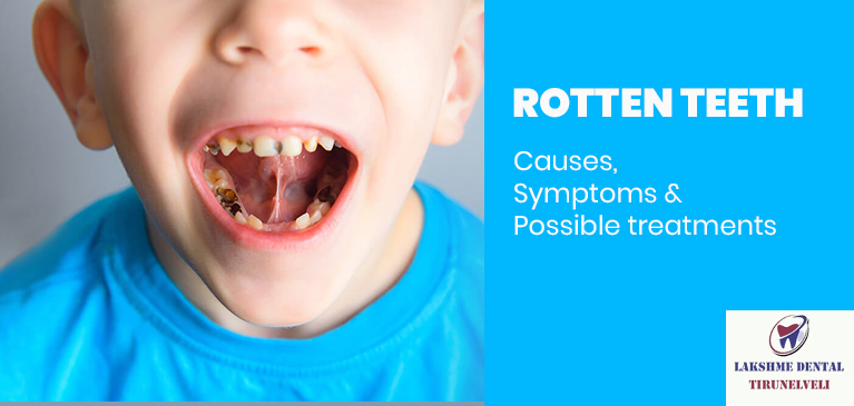 How Do You Know if Your Tooth is Rotten?