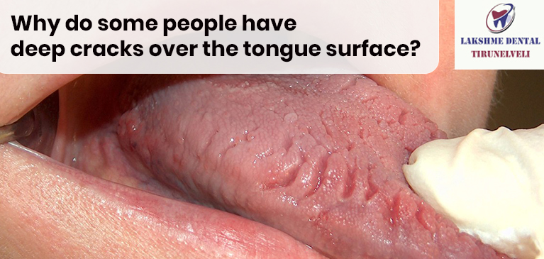 Why do some people have deep cracks over the tongue surface