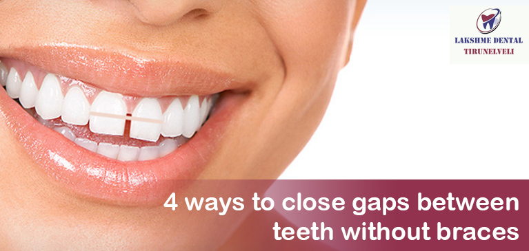 4 ways to close gaps between teeth without braces