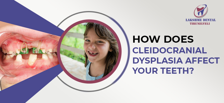 How does Cleidocranial Dysplasia affect your teeth?