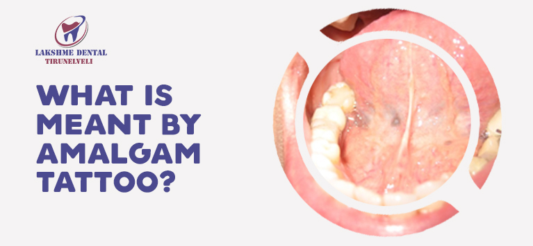 What is meant by amalgam tattoo