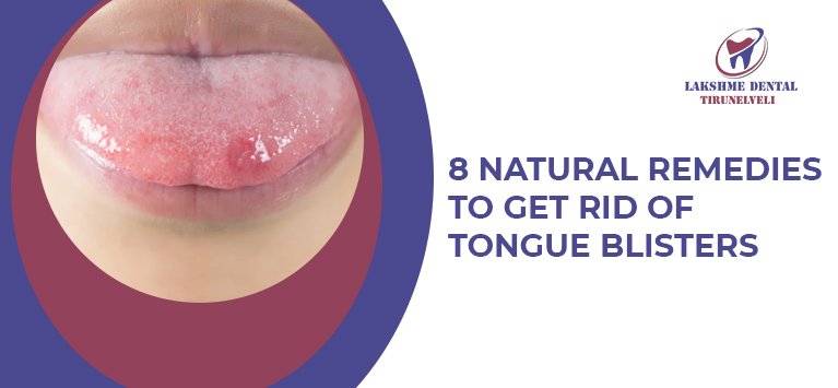 8 Natural remedies to get rid of tongue blisters