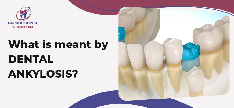 What is meant by tooth ankylosis?