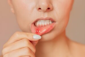 canker sore