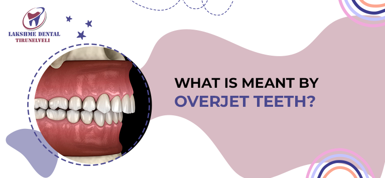 What is meant by Overjet Teeth?