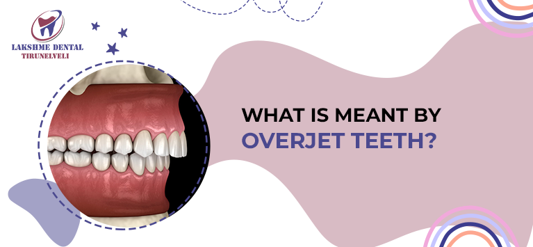 Overjet vs Overbite