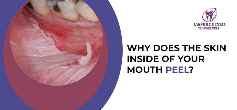 Why does the skin inside of your mouth peel?