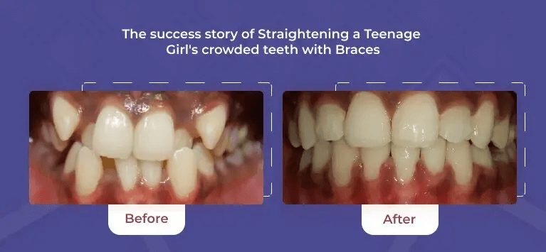 How Do Braces Actually Straighten Teeth?