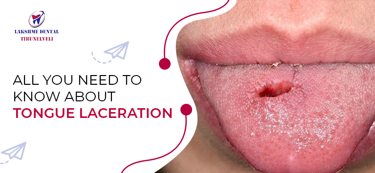 All you need to know about Tongue Laceration