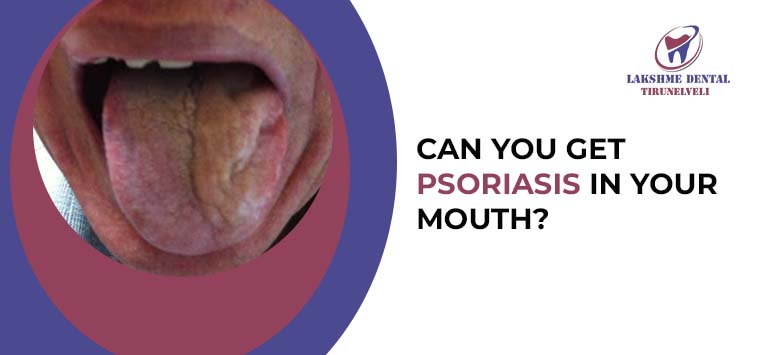 Can you get Psoriasis in your mouth?