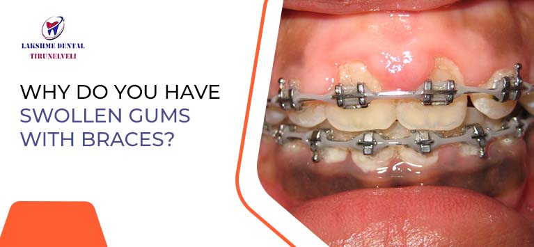 Why do you have swollen gums with braces?