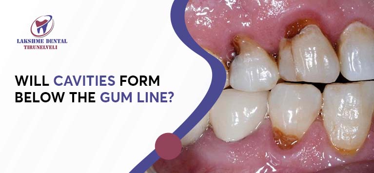 Will cavities form below the gum line?