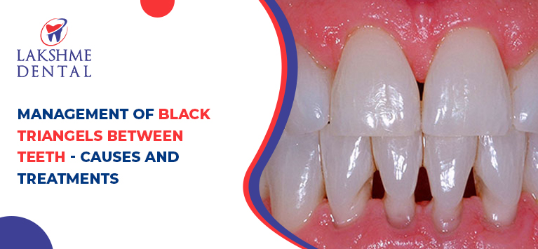 Management of black triangles between teeth - Causes and treatments