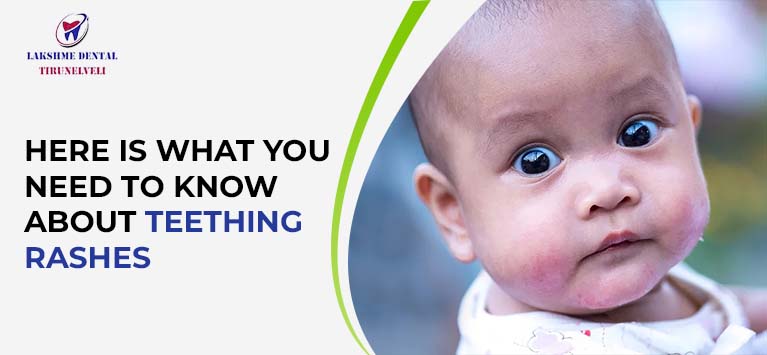 Here is what you need to know about teething rashes