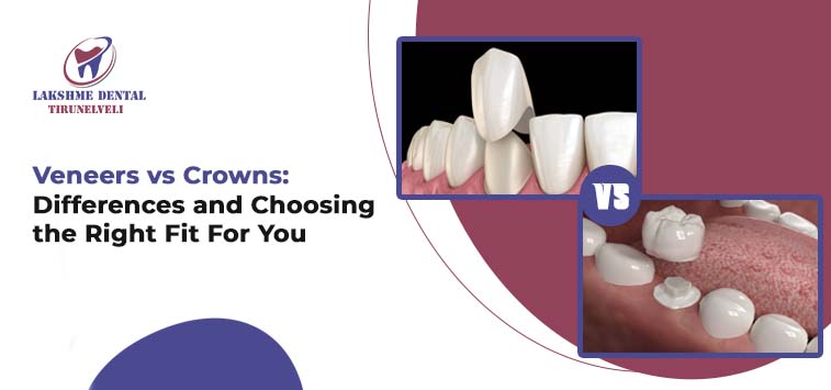 Veneers vs Crowns: Differences and Choosing the Right Fit For You