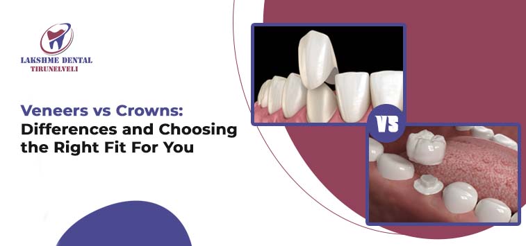 Veneers vs. Crowns: What to Know