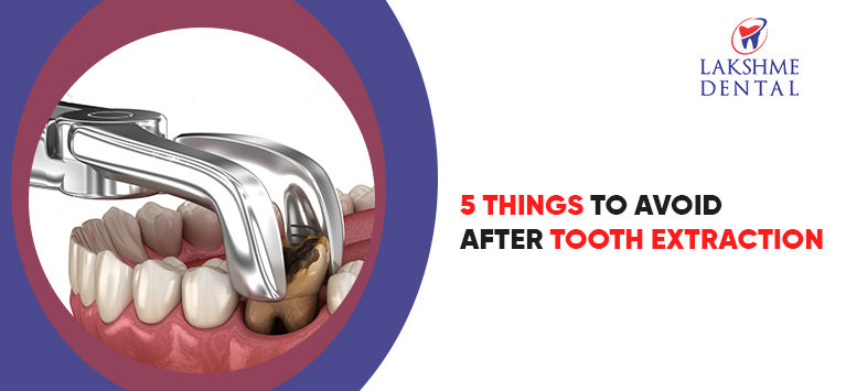 5 Things to Avoid After Tooth Extraction