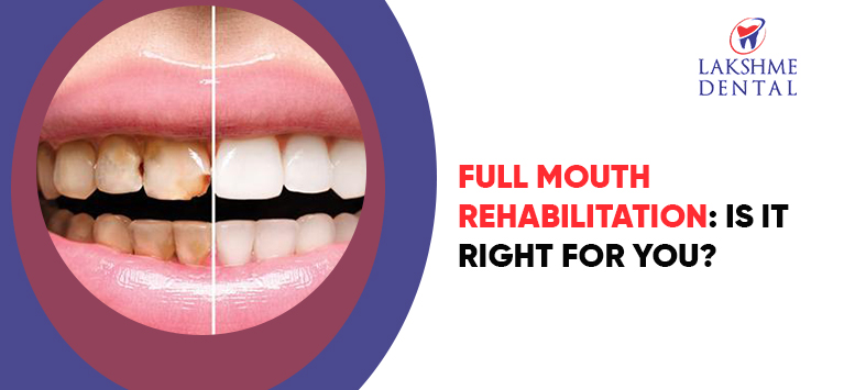 Full Mouth Rehabilitation: Is It Right for You?