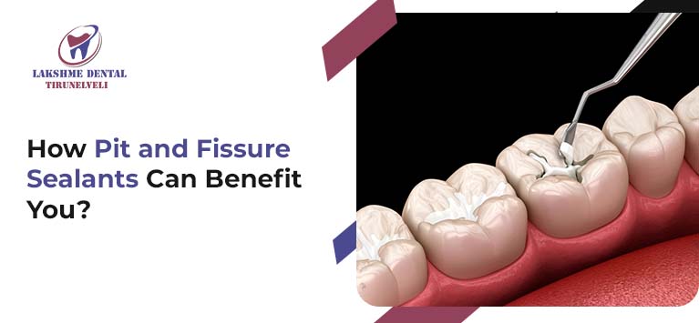 How Pit and Fissure Sealants Can Benefit You?