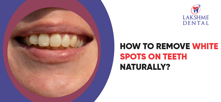 How to Remove White Spots on Teeth Naturally?