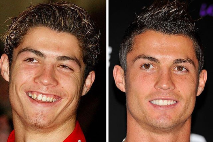 Cristiano Ronaldo Teeth Before & After