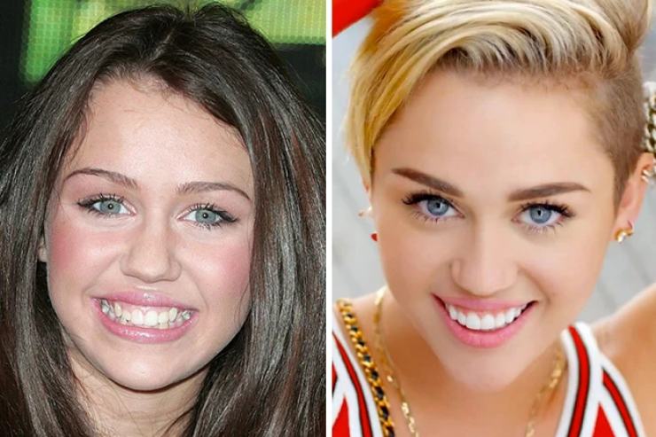Miley Cyrus Teeth Before & After
 