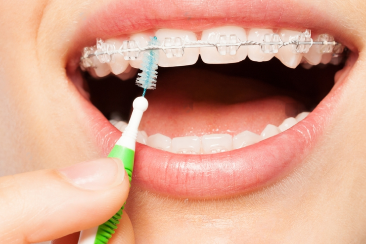 Women using Interdental Brush with Braces 