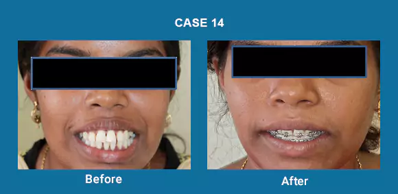 Before & After