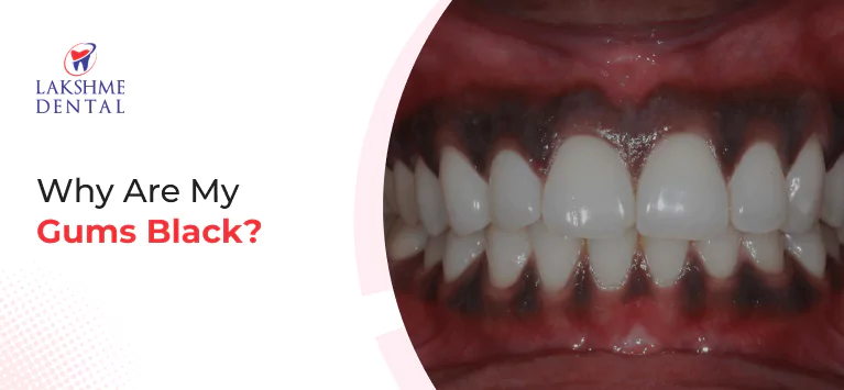 Why Are My Gums Black?