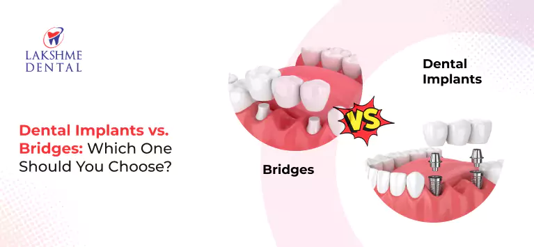 Dental Implants vs. Bridges