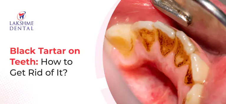 Black Tartar on Teeth