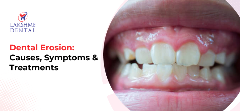 Dental Erosion