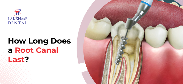 How Long Does a Root Canal Last?