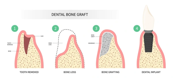 Bone Grafting