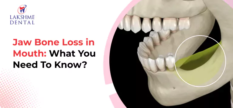 Jaw Bone Loss in Mouth