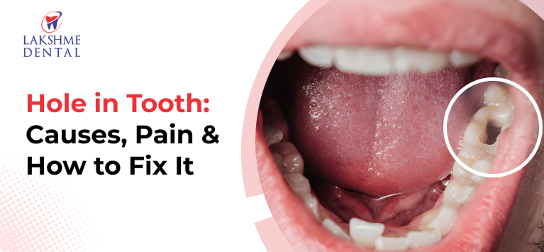 Hole in Tooth