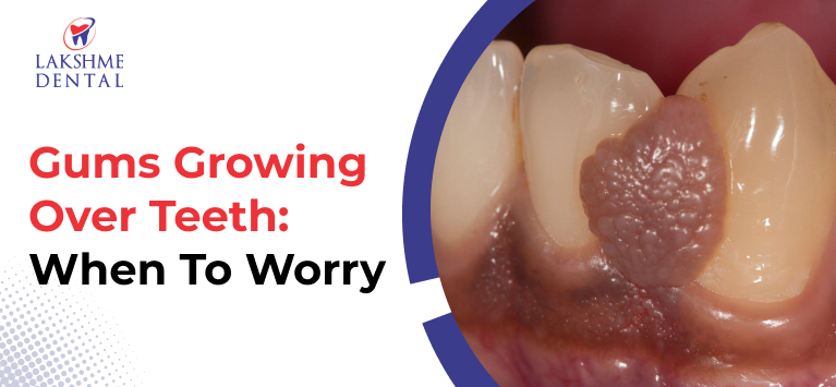 Gums Growing Over Teeth