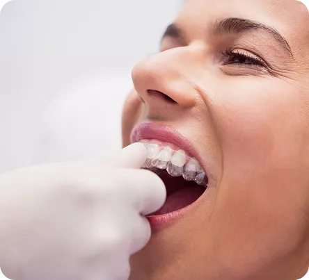 Clear Aligners (Invisible Braces)