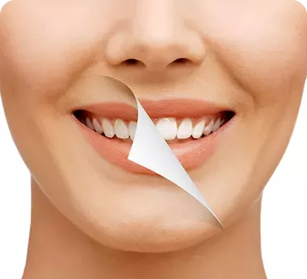 Teeth Whitening