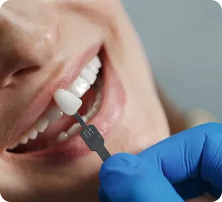 Porcelain Veneers