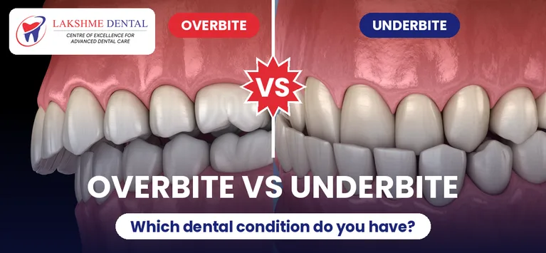 overbite-vs-underbite